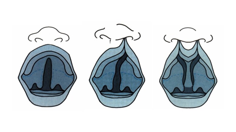 Illustration gomspalt