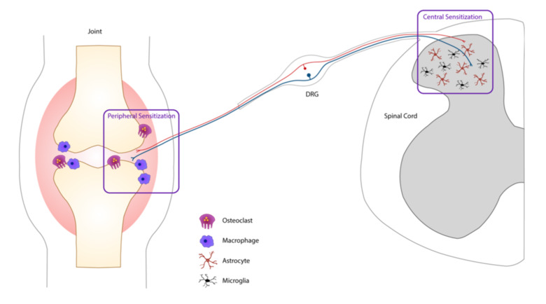An illustration of peripheral and central sensitization in rheumatoid arthritis