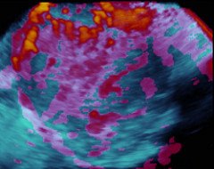 Endometrios, Comunidad MISUS från Flickr