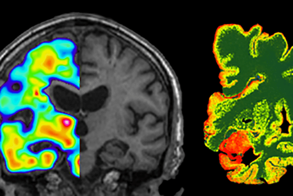 Hjärna_nvs_Agneta Nordberg