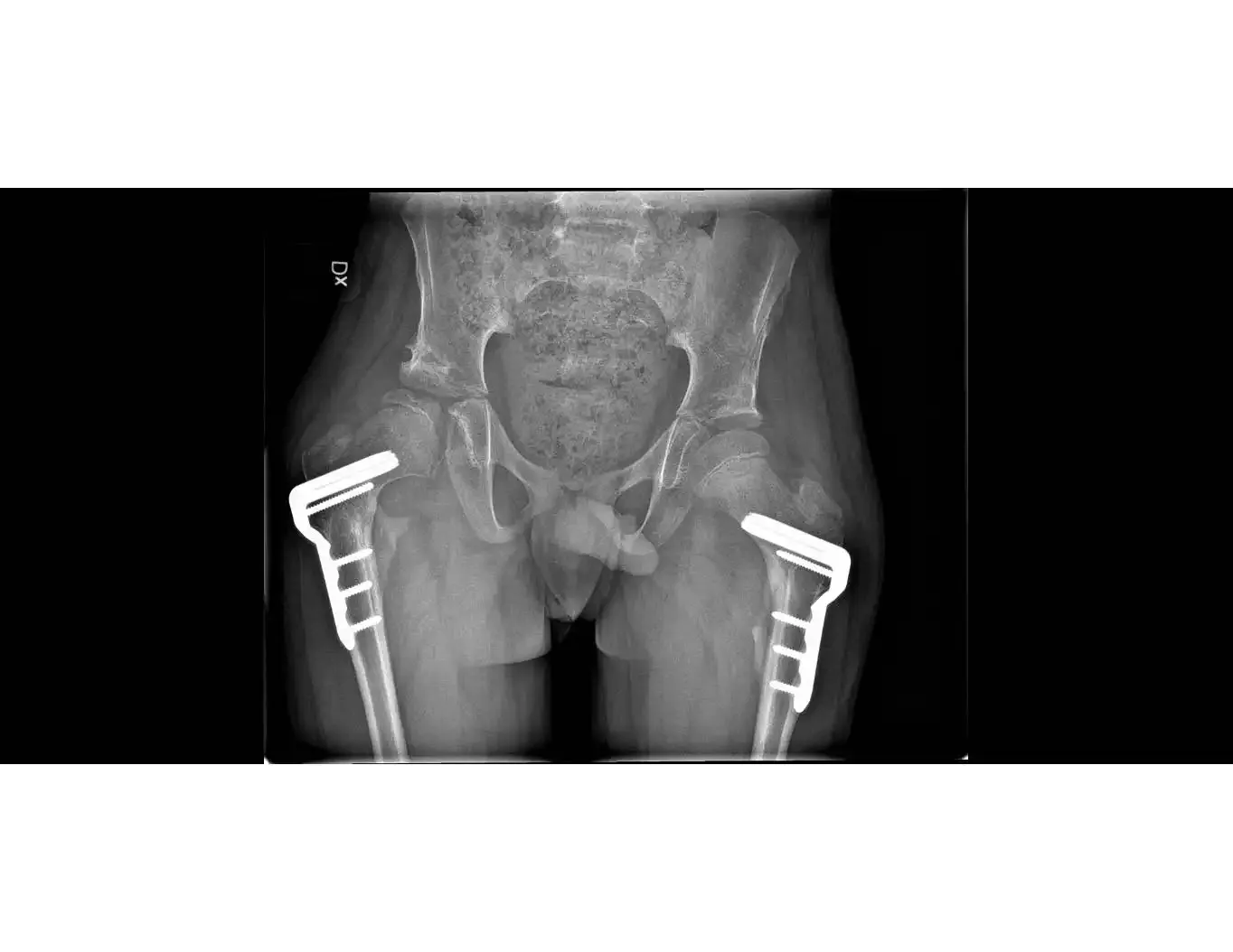 Hip joints via x-ray