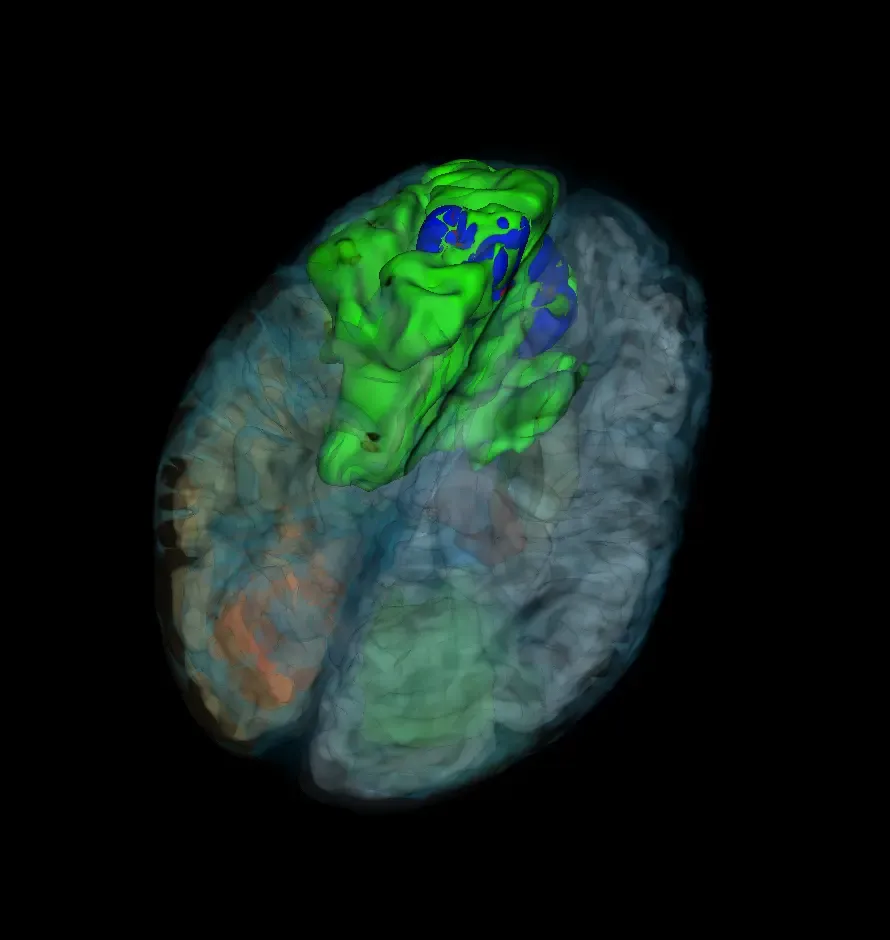 A computer generated 3D-visualization of a brain from a patient with glioma where the tumor is red, the necrotic core is blue and the edema is green.
